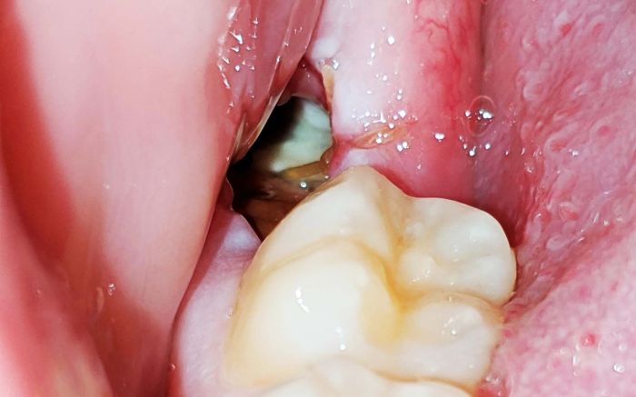 How to get food out of wisdom tooth hole