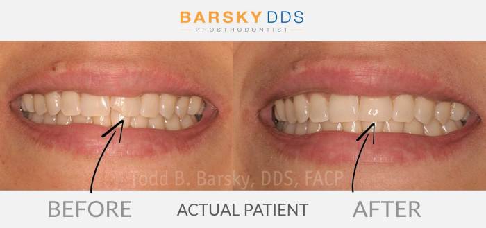 How A lot Does a Chipped Tooth Price to Repair?